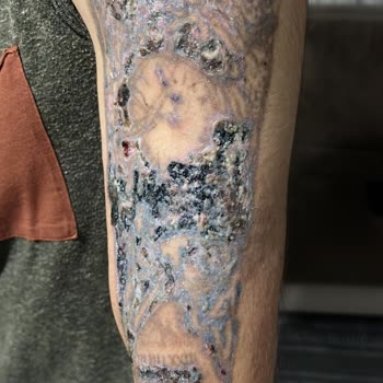 Tatto Ozan Ünsal Acılı İşlemler Ve Yanıklar