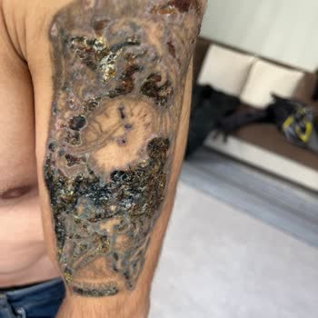 Tatto Ozan Ünsal Acılı İşlemler Ve Yanıklar