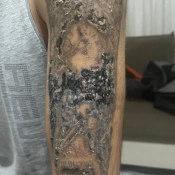 Tatto Ozan Ünsal Acılı İşlemler Ve Yanıklar
