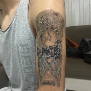 Tatto Ozan Ünsal Acılı İşlemler Ve Yanıklar