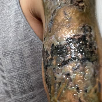 Tatto Ozan Ünsal Acılı İşlemler Ve Yanıklar