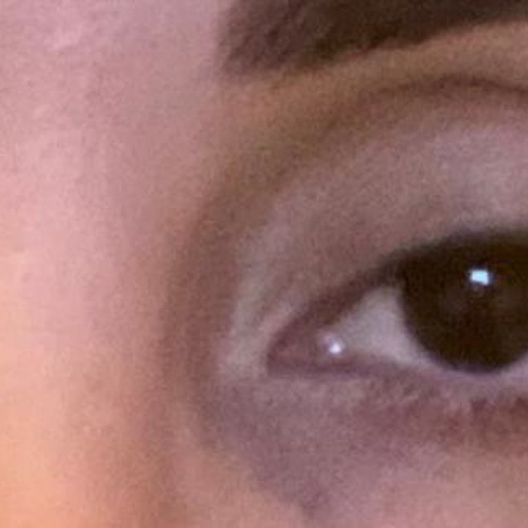 Klinikte Yaşanan Olumsuz Botox Deneyimi