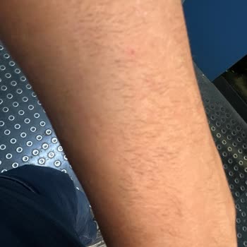 Epilasyon Hizmetinde Hayal Kırıklığı