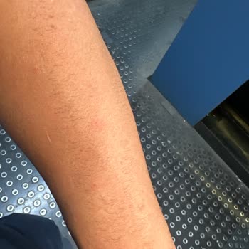 Epilasyon Hizmetinde Hayal Kırıklığı