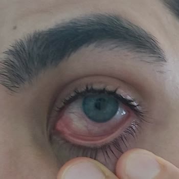 Yanlış Lens Solüsyonu Göz Sağlığımı Tehlikeye Attı