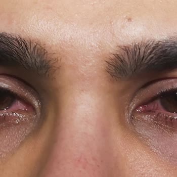 Yanlış Lens Solüsyonu Göz Sağlığımı Tehlikeye Attı