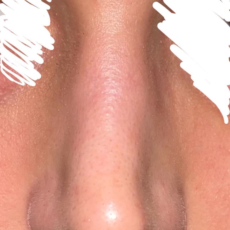 Ameliyat Sonrası Hayal Kırıklığı ve İlgisizlik