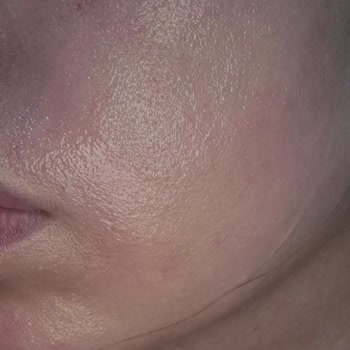 Yüz Temizleme Jelinin Ciltte Yanma Etkisi