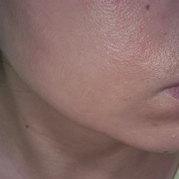 Yüz Temizleme Jelinin Ciltte Yanma Etkisi