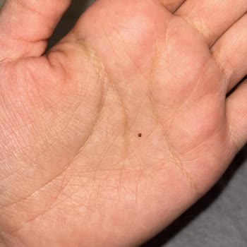 Bebek Bezinde Gizemli Noktalar ve Kaşıntı Sorunu