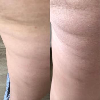 Özel Levent Dnz Polikliniği Selülit Tedavisi Sonrası Hayal Kırıklığı