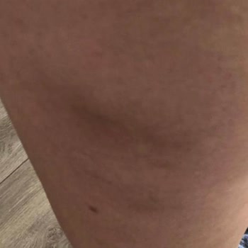 Özel Levent Dnz Polikliniği Selülit Tedavisi Sonrası Hayal Kırıklığı