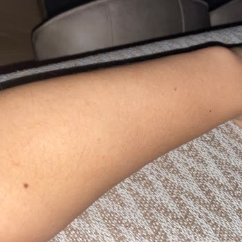 Nez Demir Ankara Şubesi'nde Buz Lazer Hayal Kırıklığı