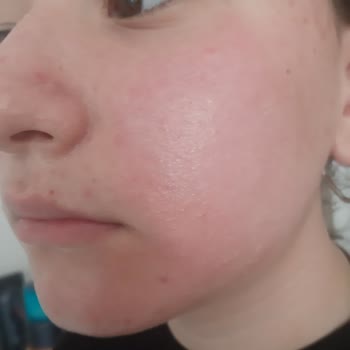 Nivea Yüz Temizleme Köpüğü Ciltte Yanma ve Kızarıklık Yapıyor