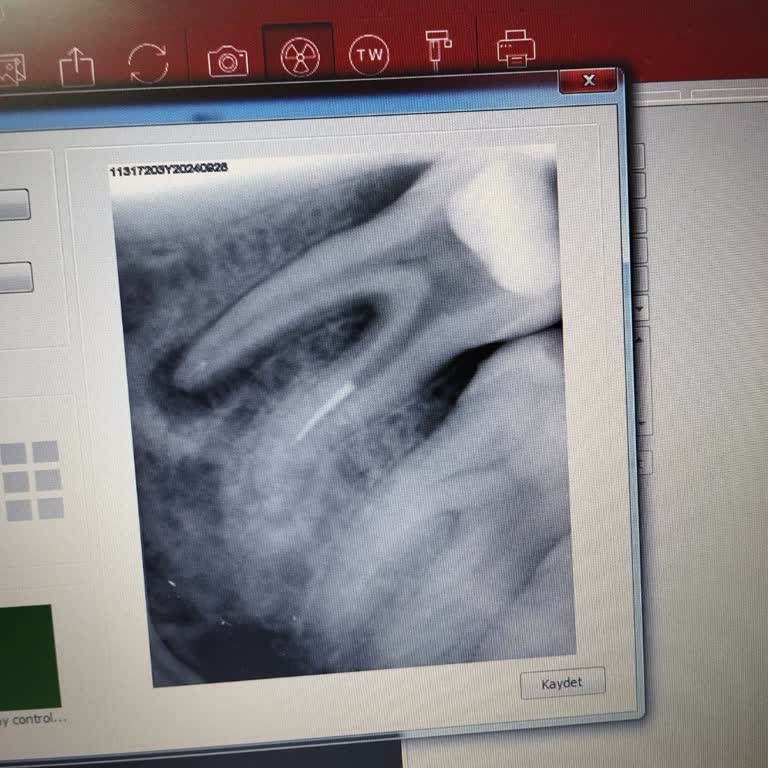 Kırık İğne Sonrası Sürekli Enfeksiyon ve Diş Kaybı