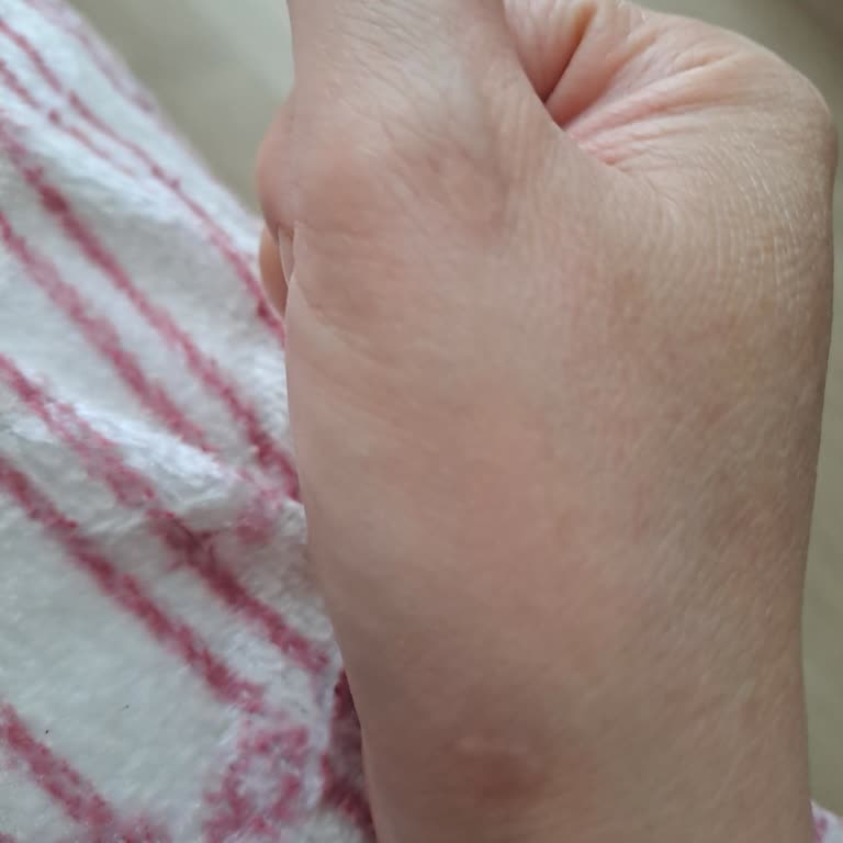 Dermatolog İşlemi Sonrası Kalıcı Yanık İzleri