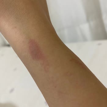 Lazer Epilasyon Paketinde Şok Fiyat Artışı ve Eksik Hizmet