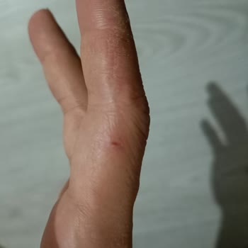 Veet Tüy Dökücü Krem Yanık ve Çatlak Sorunu