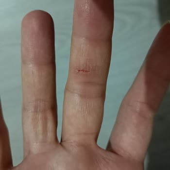 Veet Tüy Dökücü Krem Yanık ve Çatlak Sorunu