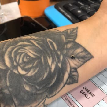 Güzellik Merkezinde Lazer Yanığı Deneyimi