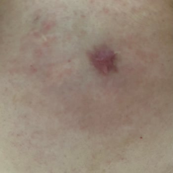 Ameliyat Sonrası Krem Reaksiyonu: Hassas Dönemde Hayal Kırıklığı