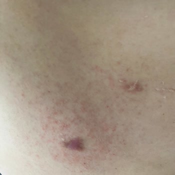 Ameliyat Sonrası Krem Reaksiyonu: Hassas Dönemde Hayal Kırıklığı