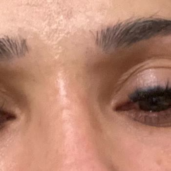 Göz Enfeksiyonu ve İlgisiz Hizmet