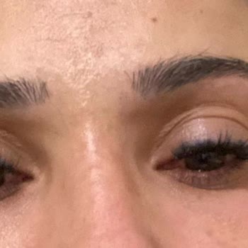 Göz Enfeksiyonu ve İlgisiz Hizmet