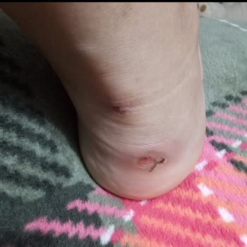 Converse Ayakkabı Ayağı Vurdu, İade Talebi