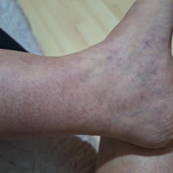 Climed Klinik Hayal Kırıklığı Yaratan Varis Tedavisi Deneyimi