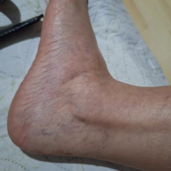 Climed Klinik Hayal Kırıklığı Yaratan Varis Tedavisi Deneyimi