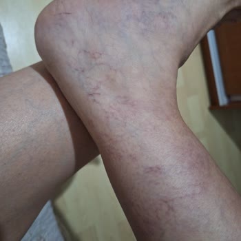 Climed Klinik Hayal Kırıklığı Yaratan Varis Tedavisi Deneyimi