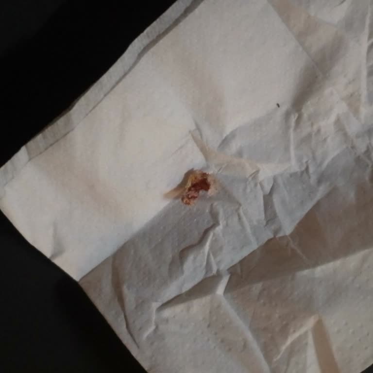 Diş Çekimi Sonrası Ağrı ve Kemik Parçaları Sorunu