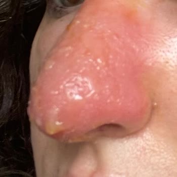 Cansu Erdem Beauty Center Burun Dolgusunda Yaşanılan Mağduriyet!