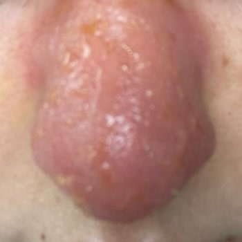 Cansu Erdem Beauty Center Burun Dolgusunda Yaşanılan Mağduriyet!