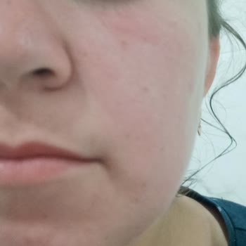 Diadermine Peeling Burned My Skin