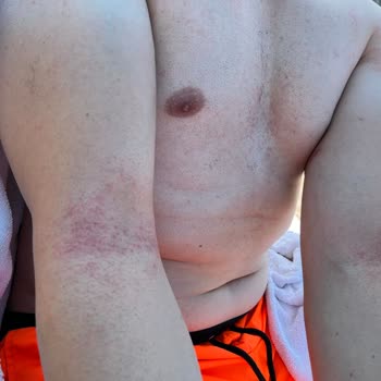 Veet Men Hair Removal Cream for Sensitive Skin Caused Burns and Redness