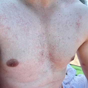 Veet Men Hair Removal Cream for Sensitive Skin Caused Burns and Redness