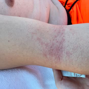 Veet Men Hair Removal Cream for Sensitive Skin Caused Burns and Redness