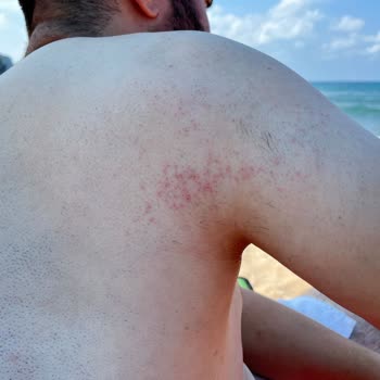 Veet Men Hair Removal Cream for Sensitive Skin Caused Burns and Redness