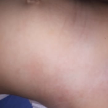 Alerjik Reaksiyon ve İlgisiz Müşteri Hizmetleri