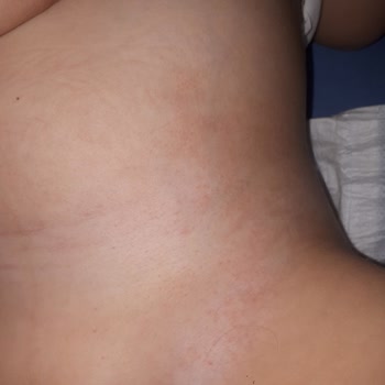 Alerjik Reaksiyon ve İlgisiz Müşteri Hizmetleri