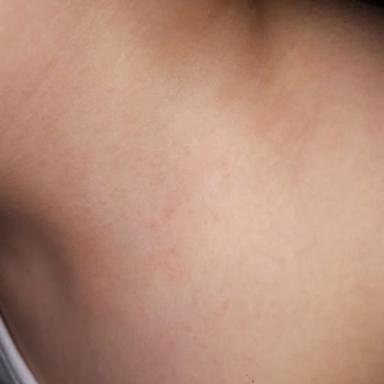 Alerjik Reaksiyon ve İlgisiz Müşteri Hizmetleri