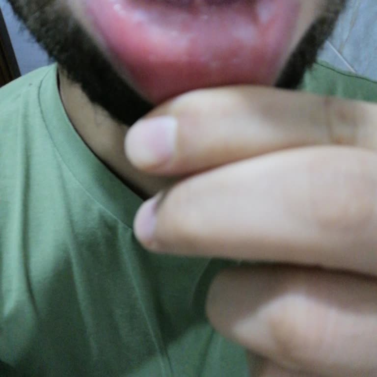 Sensodyne Sensitivity & Gum Whitening Toothpaste Caused Mouth Sores