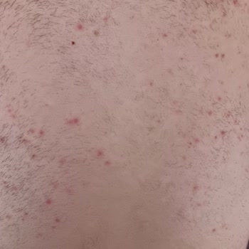 Veet Tüy Dökücü Krem Alerji Yaptı, Para İadesi İstiyorum