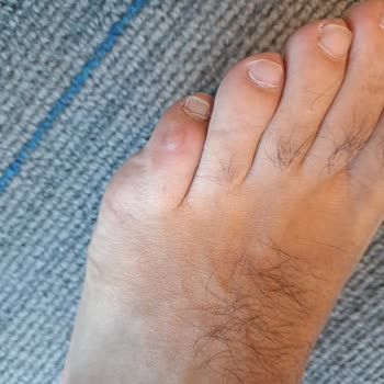 Reebok Ayakkabıda Dikim Hatası Ve Çözüm Beklentisi