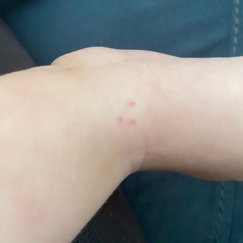 Bebek Yoğun Bakımda Damar Yolu Sorunu