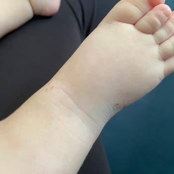 Bebek Yoğun Bakımda Damar Yolu Sorunu