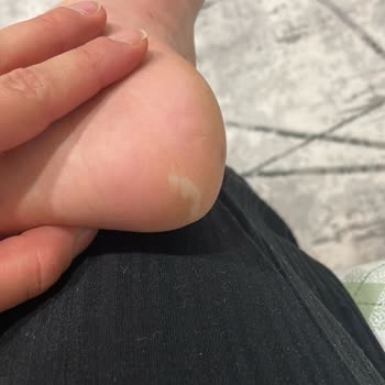 Reebok Ayakkabı Ayağı Yaraladı, Değişim Reddedildi