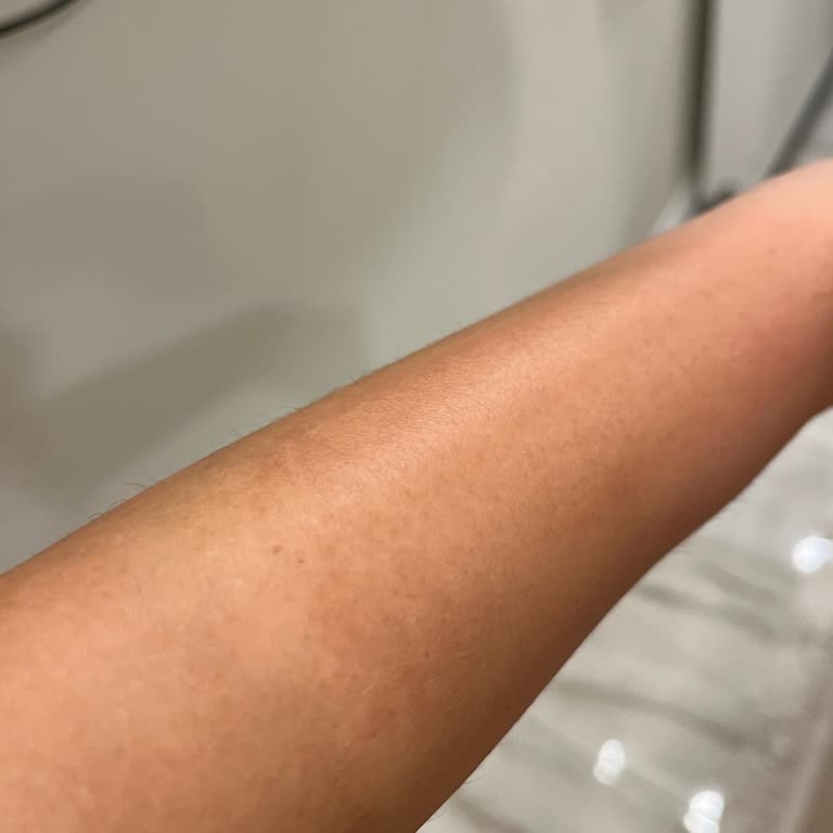 Severe Burn Marks from Veet Pure Wax Strips, Left Scar After Use